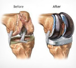 Center For Joint Replacement