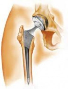 Total Hip Replacement