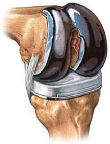 Total Knee Replacement