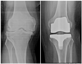 Knee Replacement