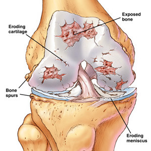 Arthritis of Knee Joint