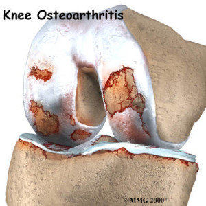 Arthritis of Knee Joint