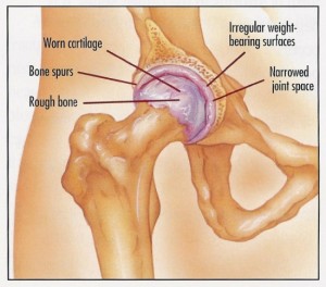 Arthritic Hip Joint