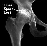Arthritic Hip Joint