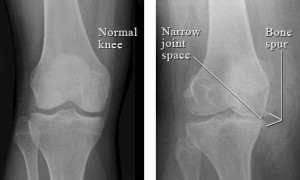 X-ray of a Normal Knee 