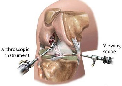 Arthroscopy