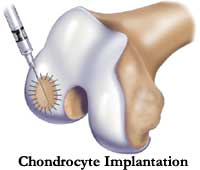 Arthroscopy