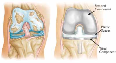 Total Knee Replacement