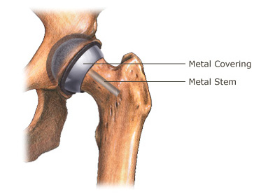 Total Hip Replacement (THR)