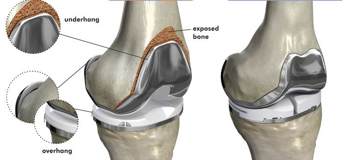 Total Knee Replacement (TKR)